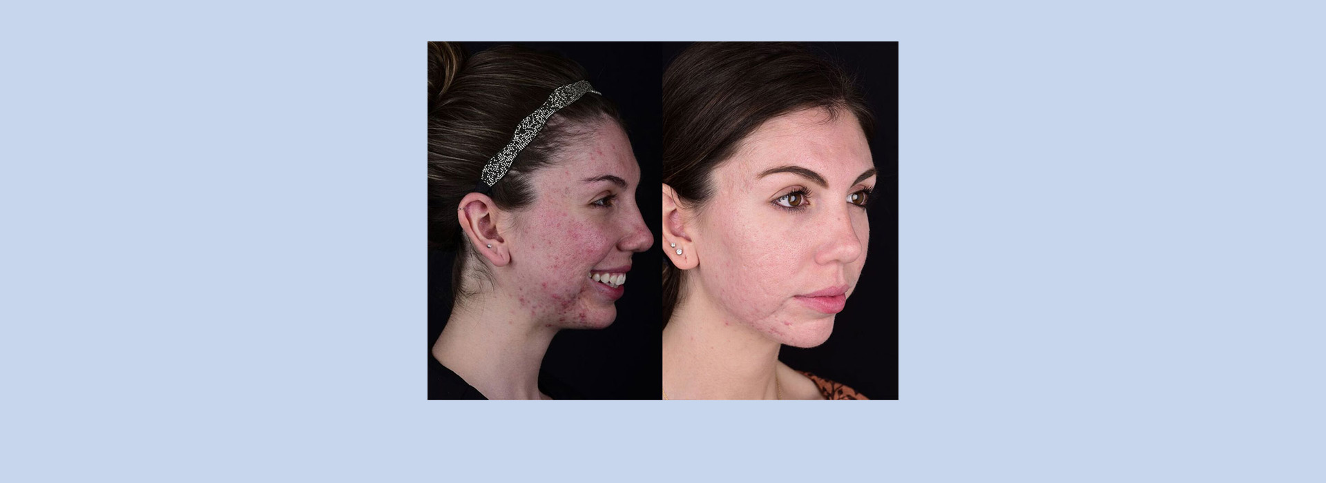 DeLand Implant Dentistry | Veneers, Implant Restorations and Laser Therapy