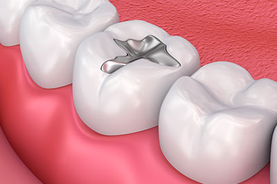 The image shows a close-up of a dental implant inserted into the upper right quadrant of a human tooth, with visible gum tissue and part of a crown.