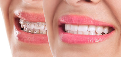 A close-up of a smiling woman s face, showcasing her teeth and lips, with the background blurred to emphasize the subject.