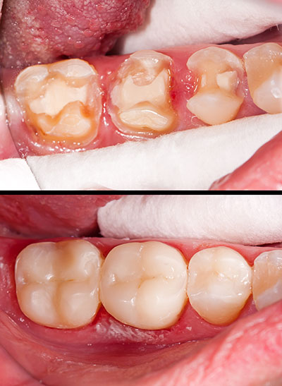 The image shows a close-up of a person s mouth with a focus on dental work, featuring a tooth with extensive decay and a large filling or restoration in the process of being placed.