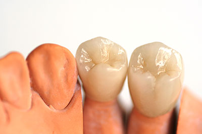 Dental implants and crowns displayed in a dental office setting.