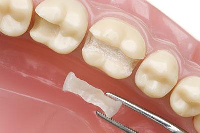 The image shows a dental implant being inserted into a tooth socket, with the surrounding teeth and gums visible.