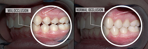 Before and after dental implant comparison with highlighted areas of interest.