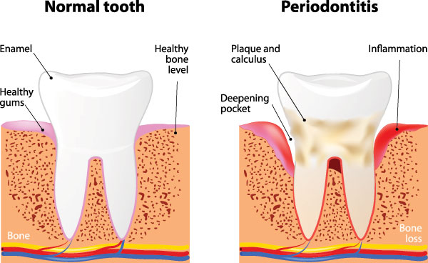 The image is a medical illustration showing the stages of tooth decay progressing from normal to periodontitis, with annotations indicating healthy bone, enamel, and gum pockets, leading to deepening cavities and bone loss.