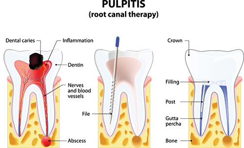 The image is an educational diagram illustrating the process of tooth extraction, showing a sequence of steps from preparation to completion.