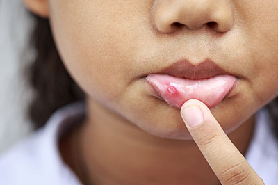 A young person with a noticeable skin condition, specifically acne, pointing to their lips.