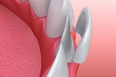 An image depicting a close-up view of a dental implant fixture with a pink gum background and a metallic screw visible, set against a blurred backdrop.