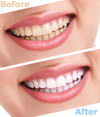 Image of a woman s smile before and after a teeth whitening treatment, highlighting the transformation with text.