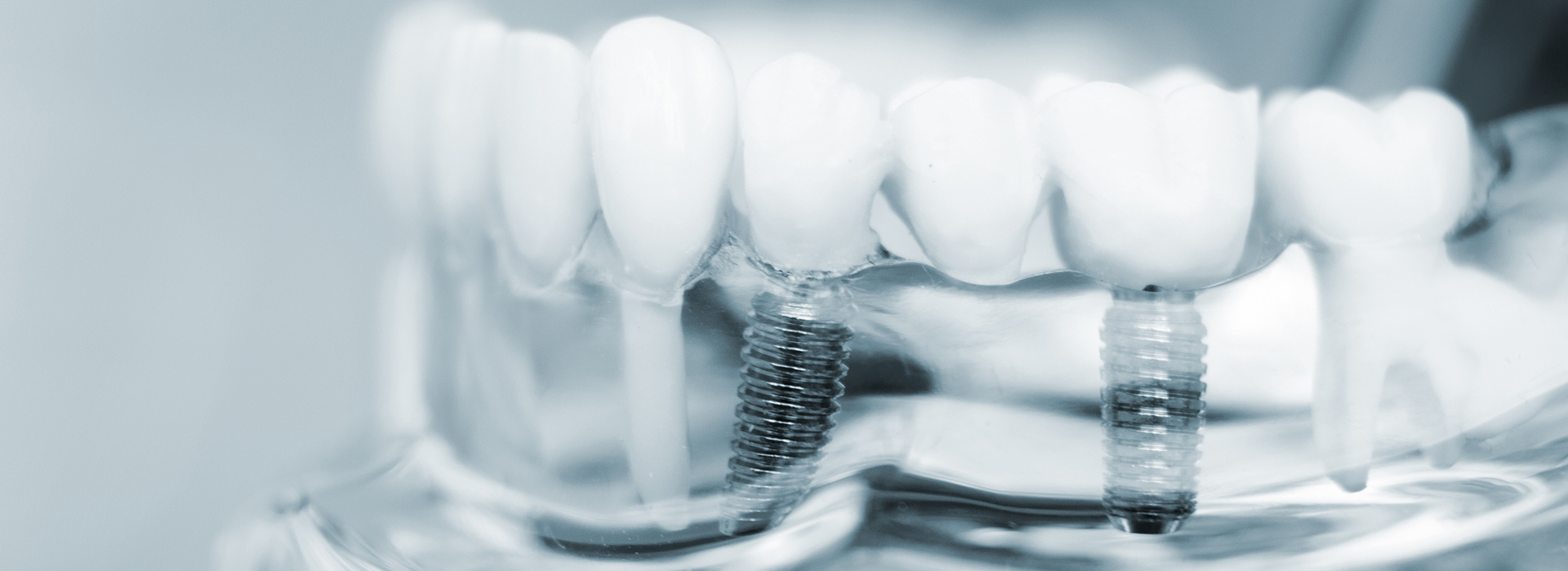 The image shows a close-up of dental implants with screws, set against a blurred background.