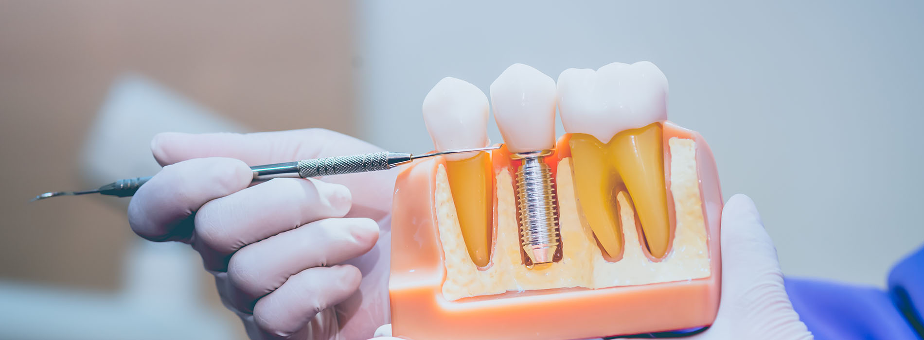 The image shows a person holding a dental implant device with a tooth implant inserted, positioned in front of a medical setting.