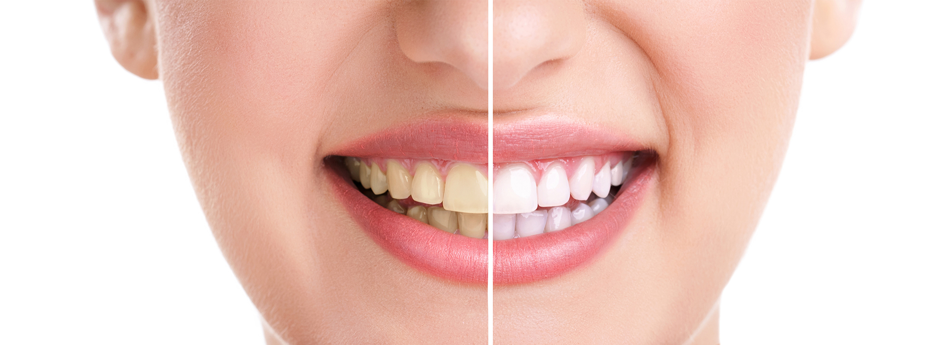 A close-up image of a smiling face with visible teeth, showcasing the effect of dental treatment or cosmetic enhancement.